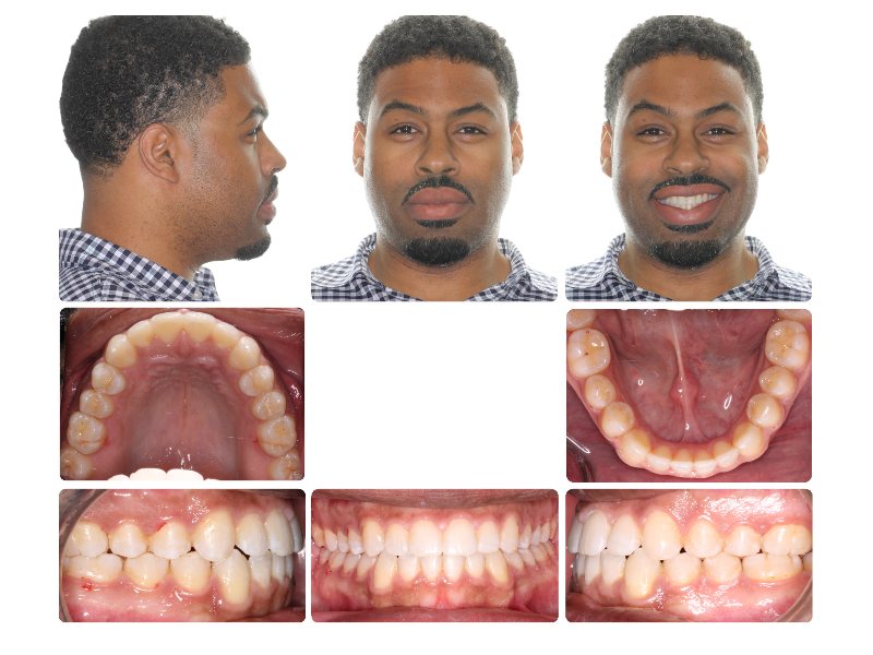 Before and Afters Mansfield Orthodontics